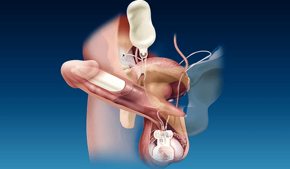 enchimentos de espessura de silicone e gel
